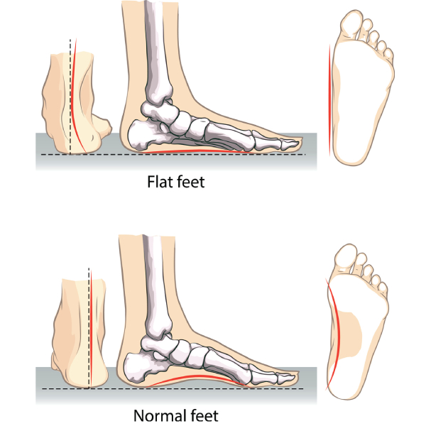 Pes Planus Uncovered – 5 Steps To Strengthen Your Feet