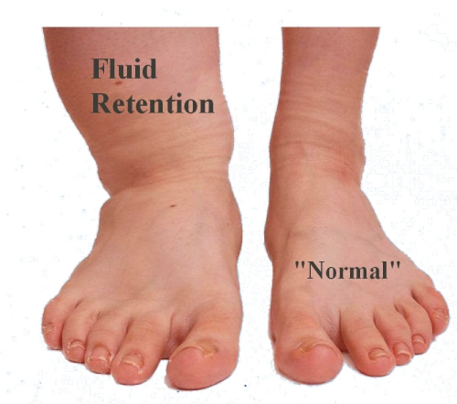 Edema