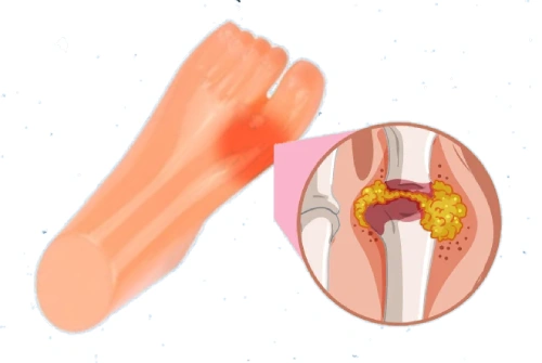 Gout