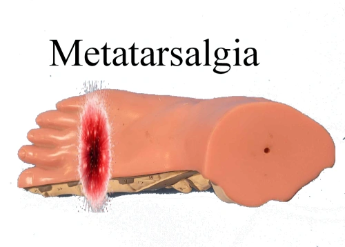 Metatarsalgia