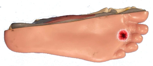 Morton Neuroma