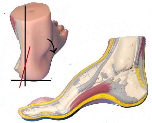 7 Steps To Comfort With Pes Cavus