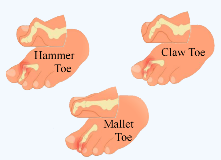 Quick Steps To Strengthen Foot Health And Combat Mallet Toes