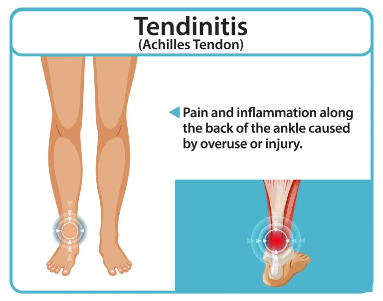 Understanding Achilles Tendonitis