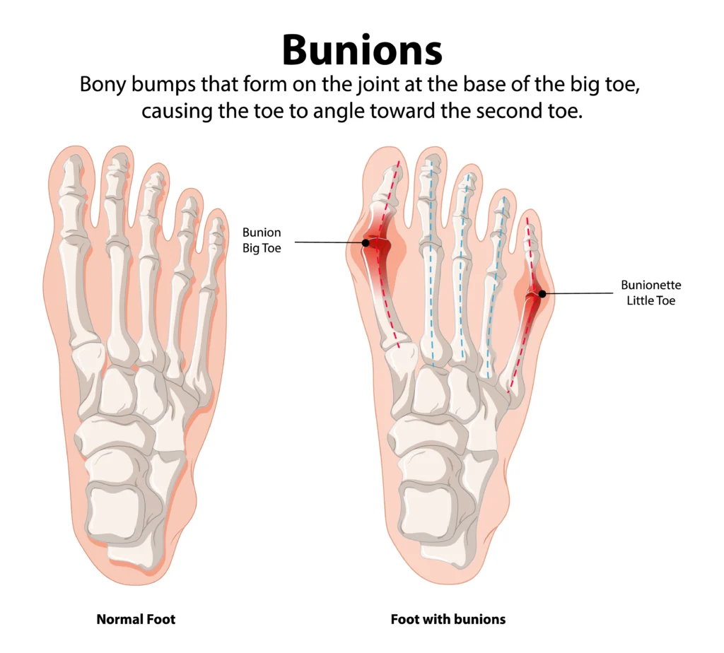 Effective Steps To Treat Bunions foot conditions