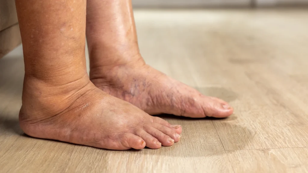 Diabetic Foot Care