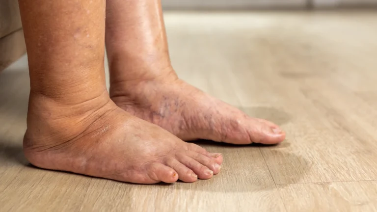 Diabetic Foot Care – Protective Footwear and Orthotics