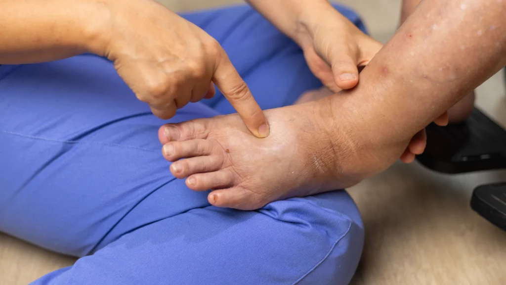 Diabetic Foot Care - Protective Footwear and Orthotics
