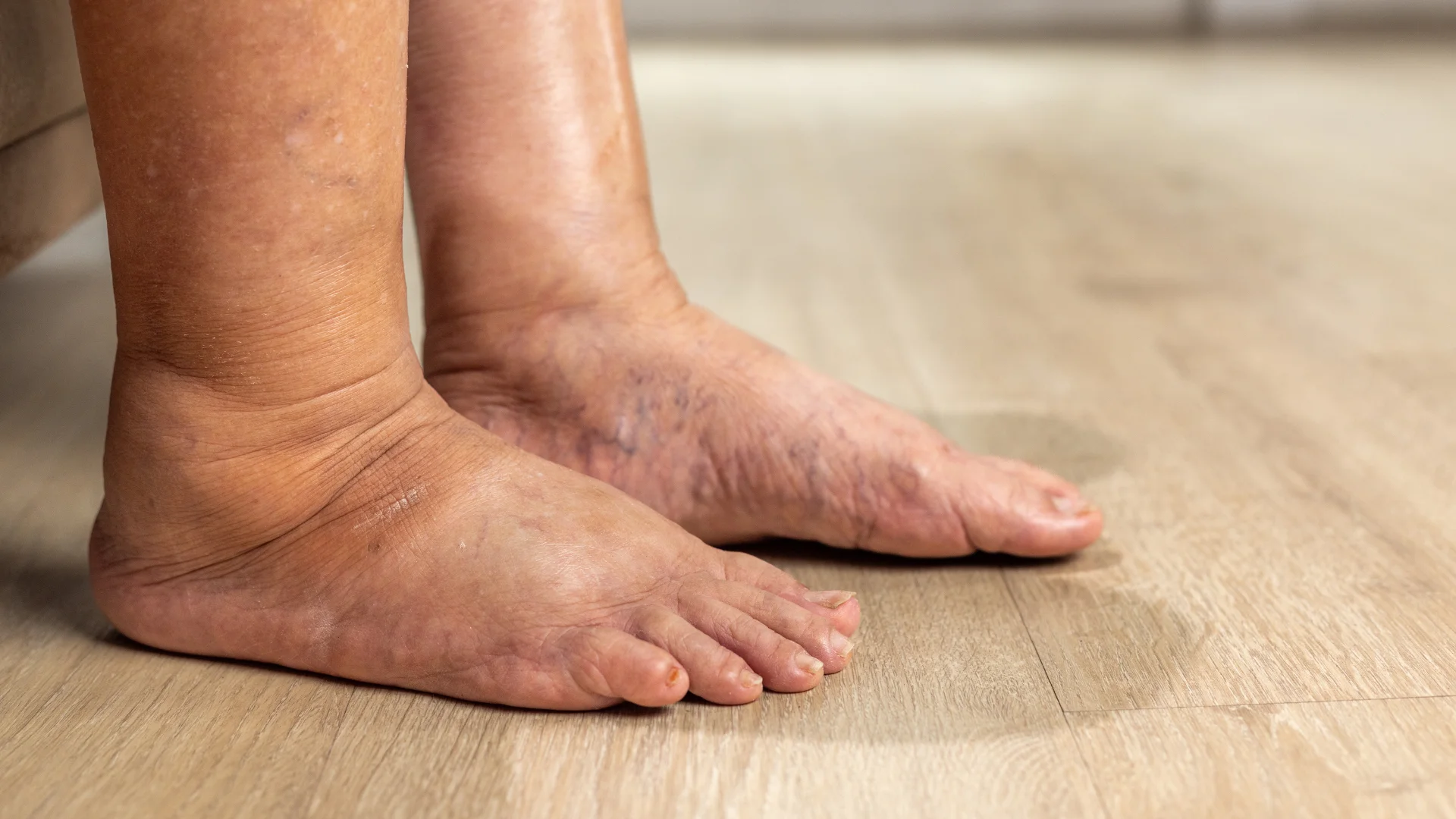 Diabetic Foot Care